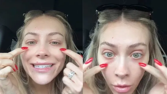 TikTok User Hannah Chody Warns Against Under-Eye Fillers After Experiencing Unexpected Migration