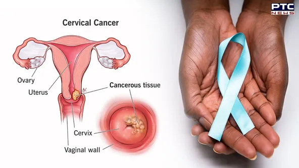 Cervical 