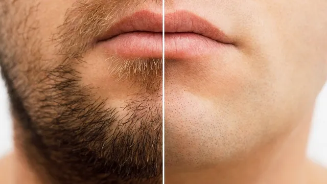 How Does Facial Hair Removal Impact Skincare?