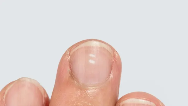 White spot on a nail - Stock Image - C034/8019 - Science Photo Library
