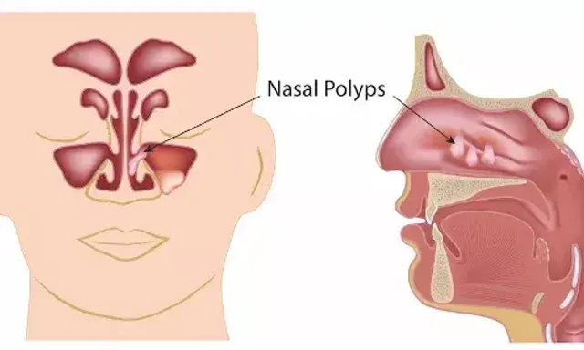 સમયસર સારવાર નાકના પોલિપ્સમાં રાહત આપશે, આ લક્ષણોને અવગણશો નહીં