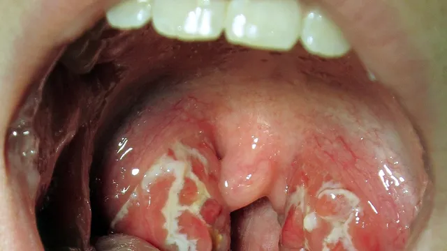 What Causes White Spots on the Back of the Throat?