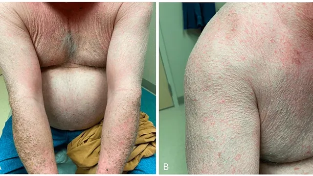 Hereditary-Hemochromatosis-Causes-Symptoms-Diagnosis-Best-Dr-Qaisar-Ahmed-Risalpur-KPK-Pakistan