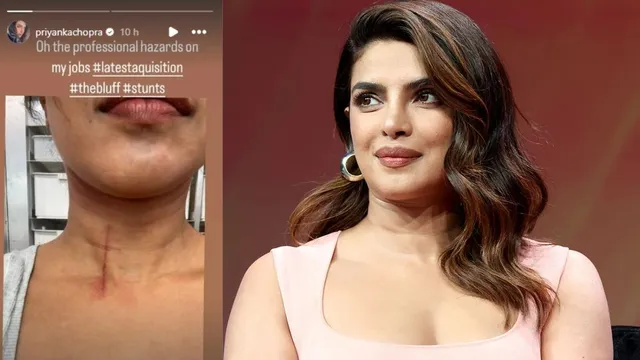 Priyanka Chopra Jonas sustained a minor injury