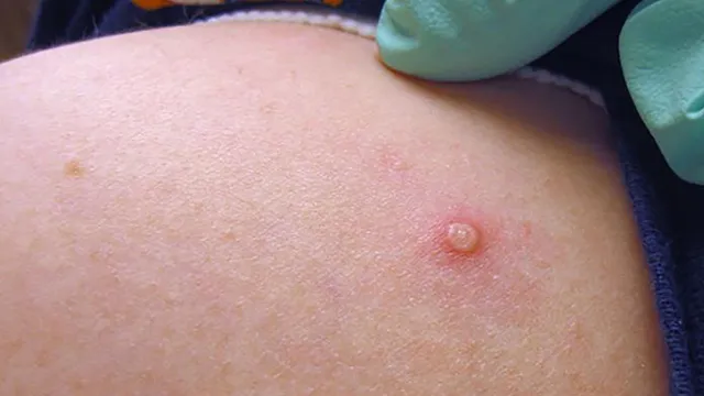 Prevent Monkeypox Spread 