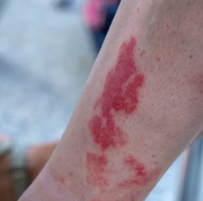 Dancing in an overheated club can leave you with a nasty rash. Sarah2/Shutterstock