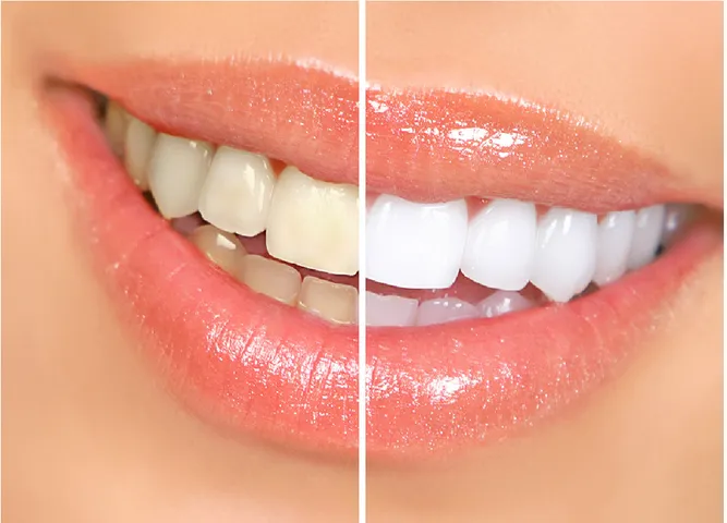 શું તમારા દાંત પણ પીળા છે ? અહી છે ફાયદાકારક ઉપાય